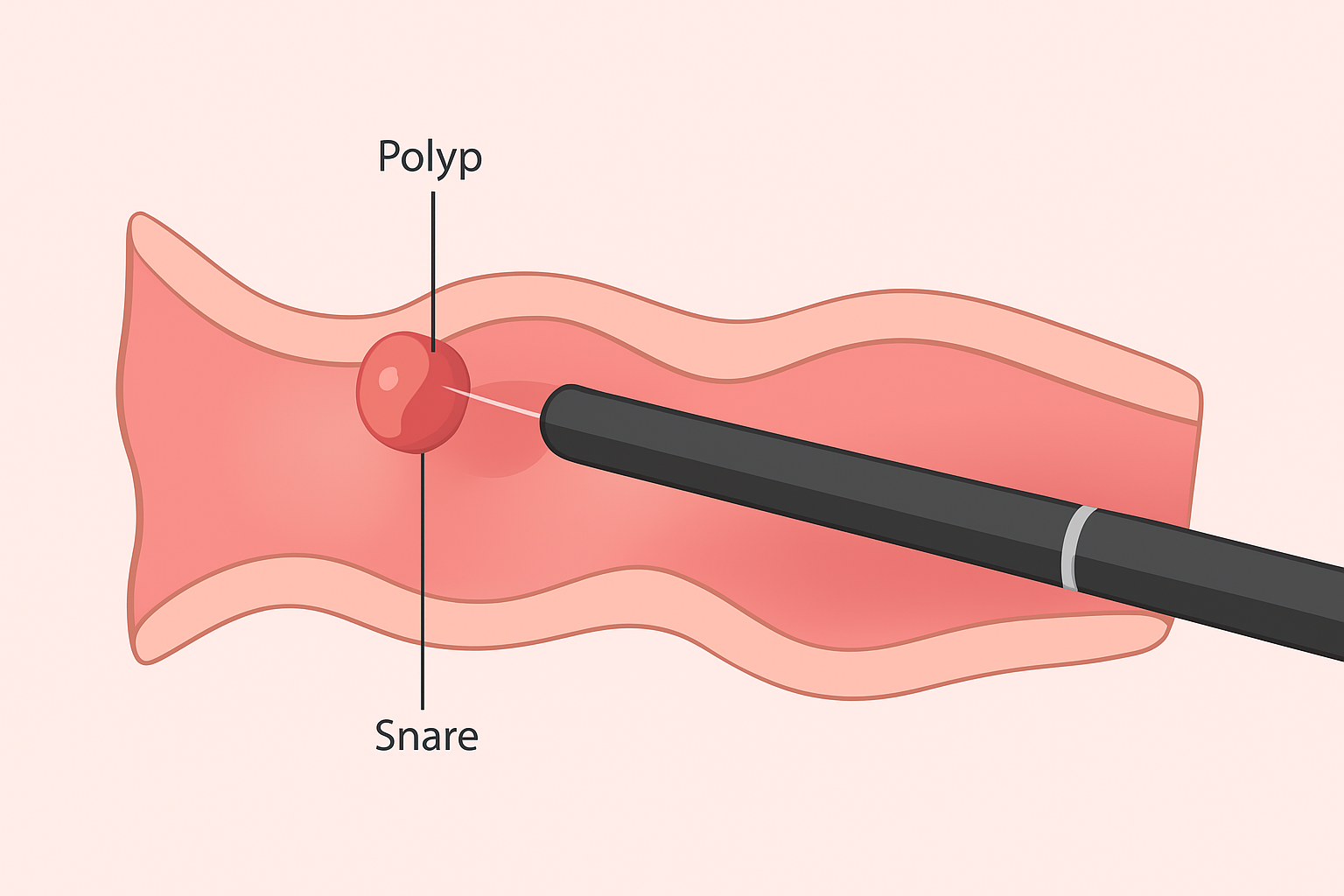 Polypectomy
